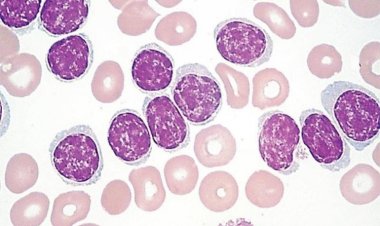 Запатентован новый способ диагностики лейкозов