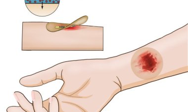 Беспроводной «умный» пластырь быстрее заживляет хронически раны на коже