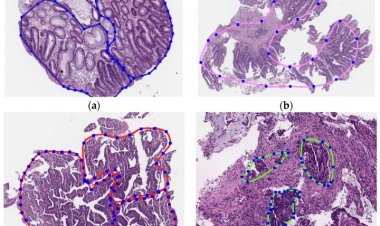 В России научили нейронные сети распознавать рак