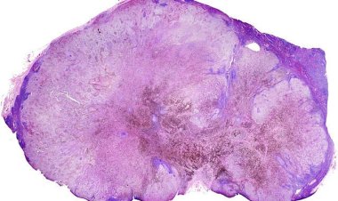 Один из основных препаратов от меланомы оказался виновником лекарственной устойчивости рака