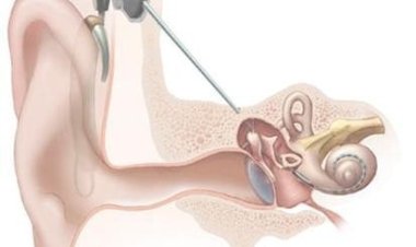 Нейроинженерия поможет глухим и слепым