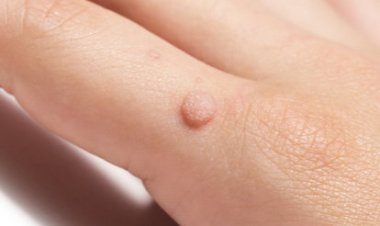 Врач объяснила, что бородавки нельзя удалять без участия врачей потому, что можно получить ожог или аллергию